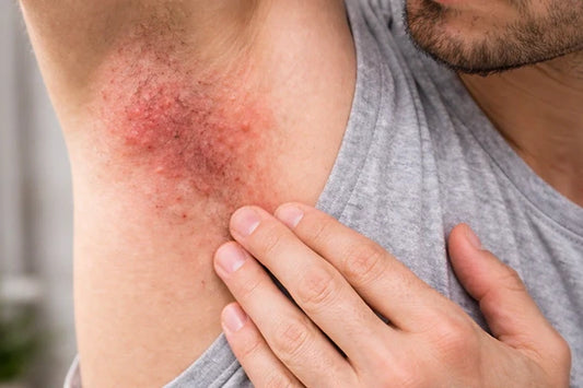 Underarm Rash from Alcohol in Deodorant
